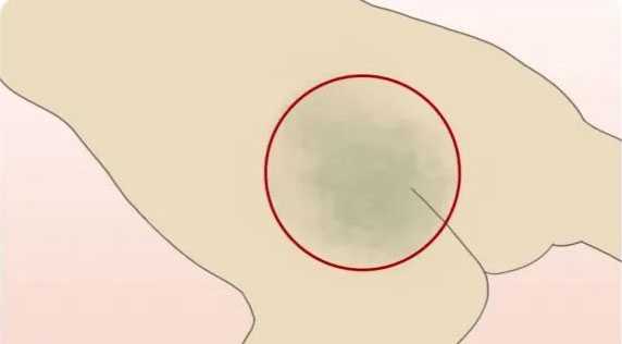 为什么婴儿屁股上有“淤青”？