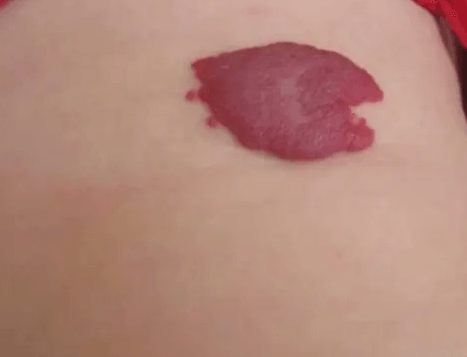 昆明协大皮肤病医院：婴儿血管瘤好治吗？