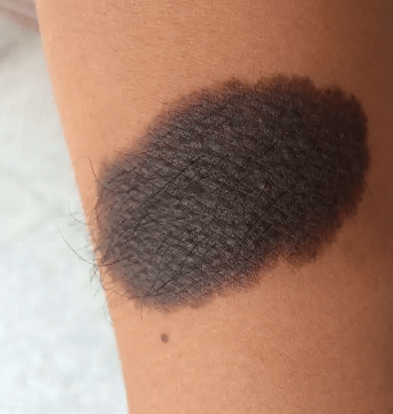 什么是兽皮痣 什么是兽皮痣