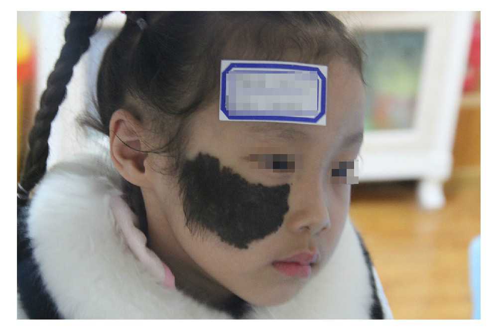 1656550895123379.jpg 黑毛痣.jpg