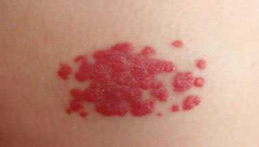 血管瘤治疗之后会复发吗？